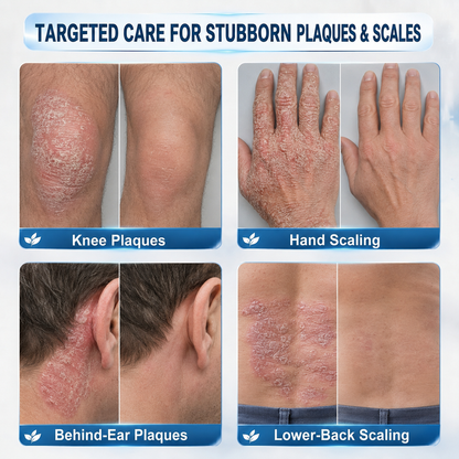 𝐇𝐈𝐒𝐊𝐈𝐍® 👩‍⚕️Calming Care for Psoriasis-Prone Skin  |7-Day Soothing Rollerball Pen Painless · Skin-Friendly · Targeted Psoriasis & Flaky Skin Care Rollerball