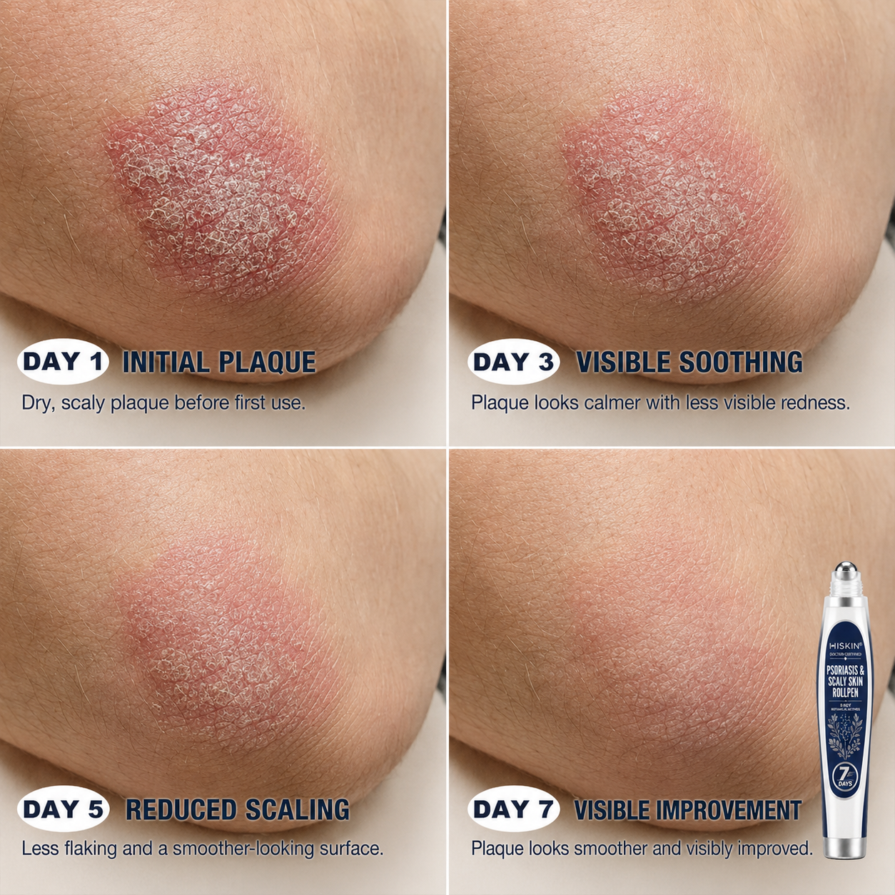 𝐇𝐈𝐒𝐊𝐈𝐍® 👩‍⚕️Calming Care for Psoriasis-Prone Skin  |7-Day Soothing Rollerball Pen Painless · Skin-Friendly · Targeted Psoriasis & Flaky Skin Care Rollerball