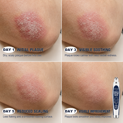 𝐇𝐈𝐒𝐊𝐈𝐍® 👩‍⚕️Calming Care for Psoriasis-Prone Skin  |7-Day Soothing Rollerball Pen Painless · Skin-Friendly · Targeted Psoriasis & Flaky Skin Care Rollerball