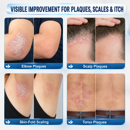 𝐇𝐈𝐒𝐊𝐈𝐍® 👩‍⚕️Calming Care for Psoriasis-Prone Skin  |7-Day Soothing Rollerball Pen Painless · Skin-Friendly · Targeted Psoriasis & Flaky Skin Care Rollerball